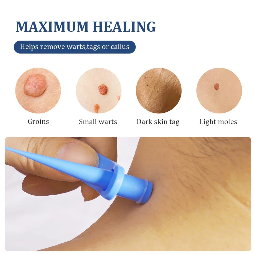 2-in-1 Auto Skin Tag Removal Kit