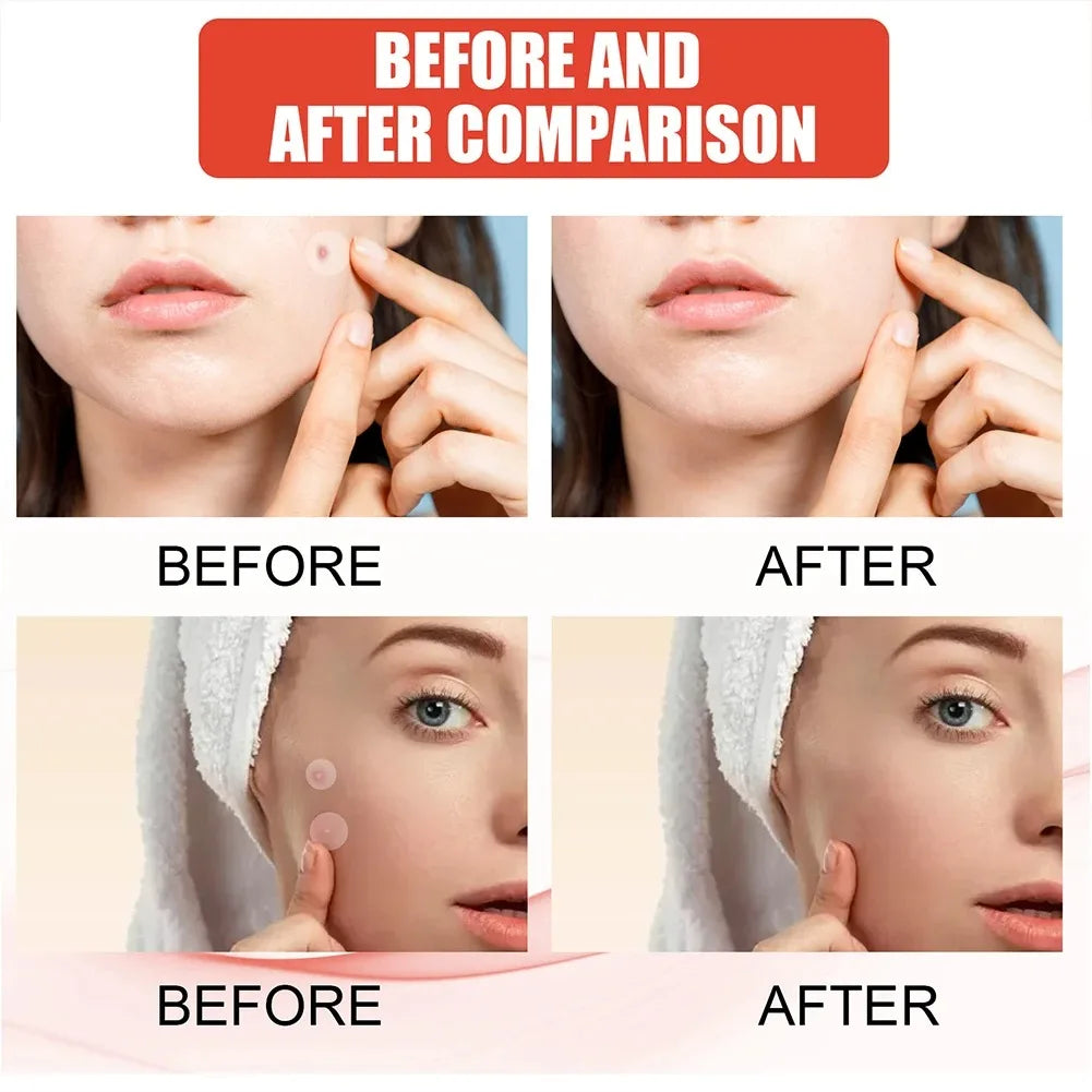 Acne Pimple Patches – Overnight Absorbing Stickers for Clearer Skin ✨